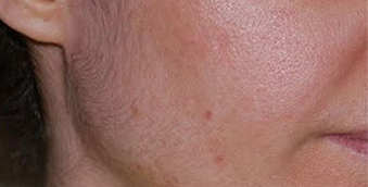 after acne treatment west vancouver