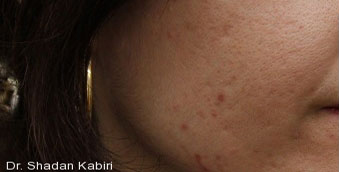before acne treatment west vancouver
