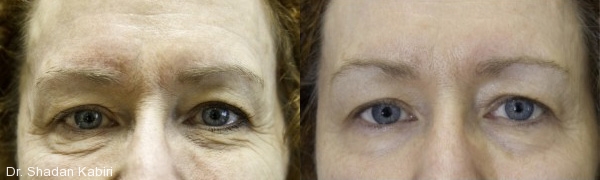dr. shadan kabiri exilis elite before and after