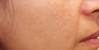 after rosacea treatment west vancouver