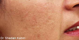before rosacea treatment west vancouver