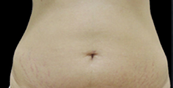 before stretch mark treatment dr. shadan kabiri