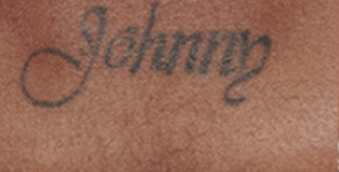 before picoclear tatto removal west vancouver