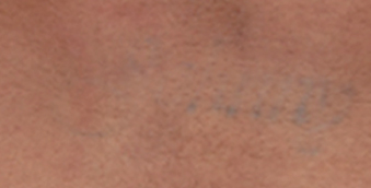 after picoclear tatto removal west vancouver