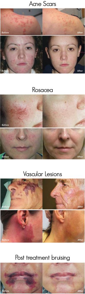 vbeam perfecta before and after treatment