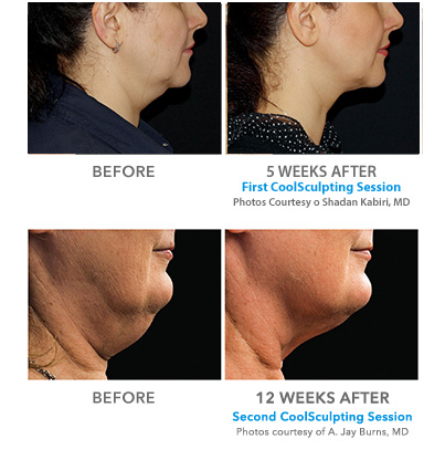before and after coolsculpting procedure on neck