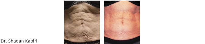 venus legacy body before and after