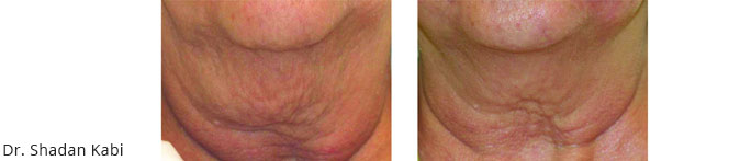 venus legacy neck before and after with dr. shadan kabiri