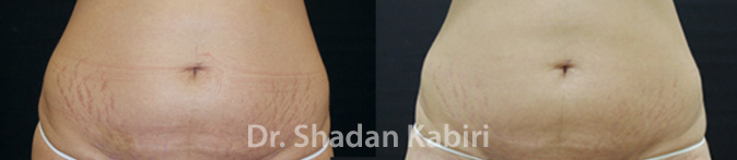 venus legacy stomach before and after