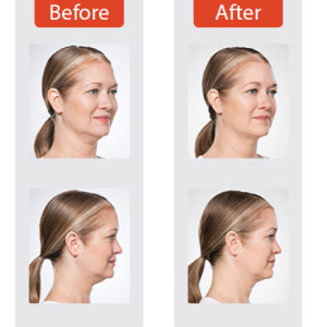 female before and after belkyra in west vancouver