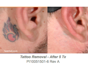 tattoo removal after 5 picoclear laser treatments