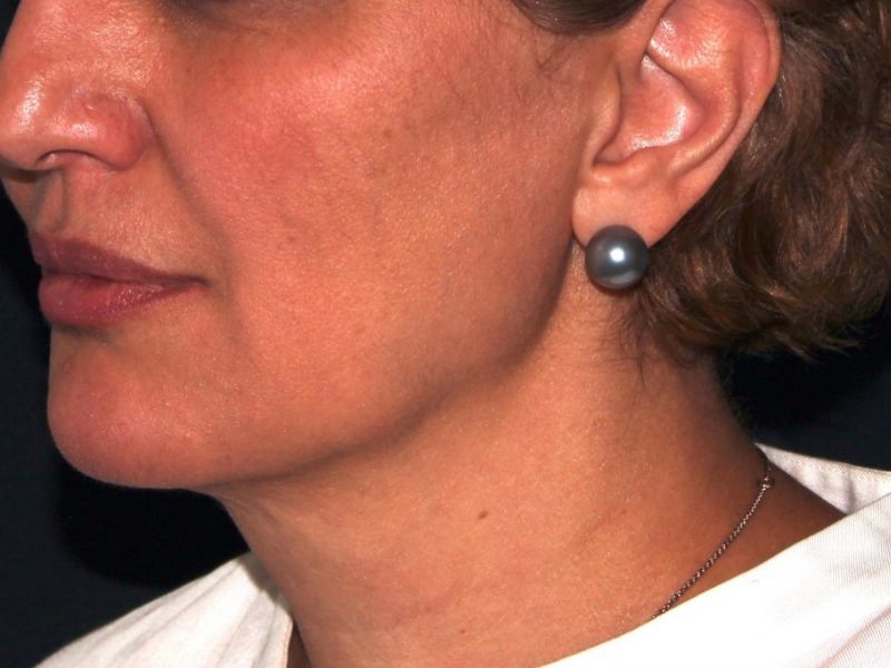 after non-surgical facelift neck lift left angle view female patient case 1423