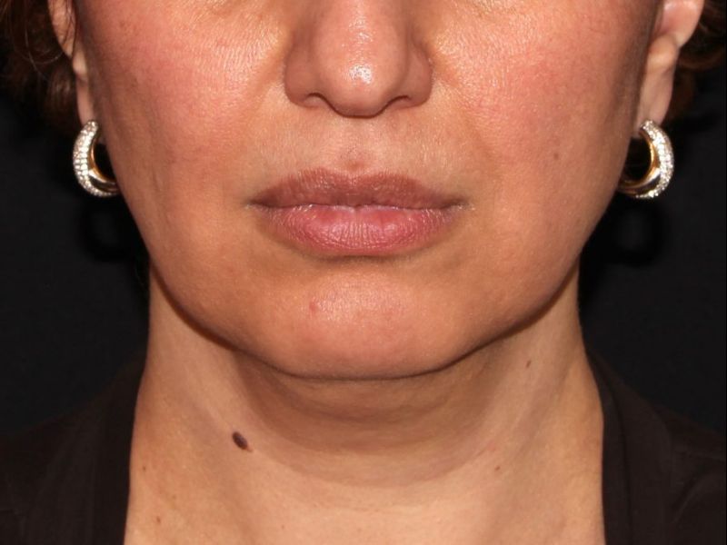 before non-surgical facelift neck lift front view female patient case 1423