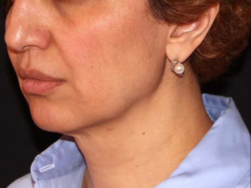 before non-surgical facelift neck lift left angle view female patient case 1423