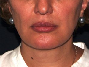 after non-surgical facelift neck lift front view female patient case 1423