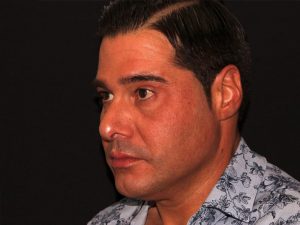 after non-surgical facelift neck lift left angle view male patient case 1416