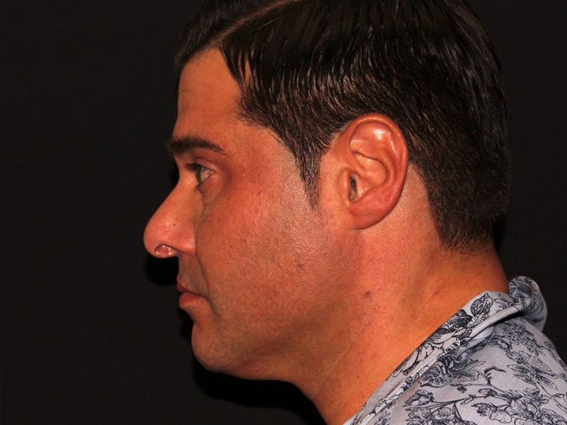 after non-surgical facelift neck lift left view male patient case 1416