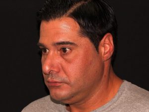 before non-surgical facelift neck lift left angle view male patient case 1416