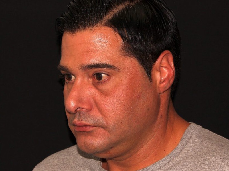 before non-surgical facelift neck lift left angle view male patient case 1416