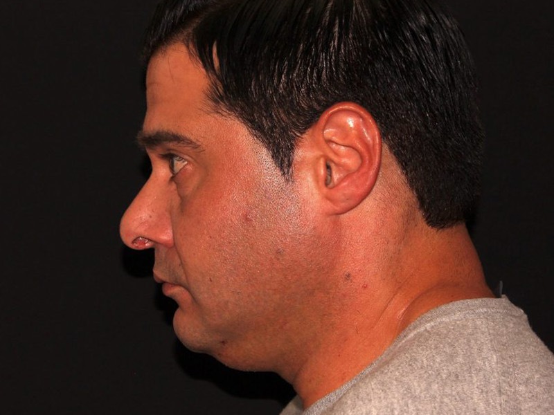 before non-surgical facelift neck lift left view male patient case 1416