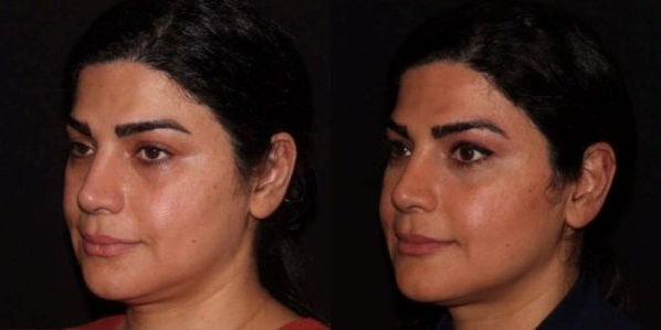 before and after microneedling left angle view female patient