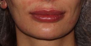 after lip augmentation front closed mouth view female patient case 1541