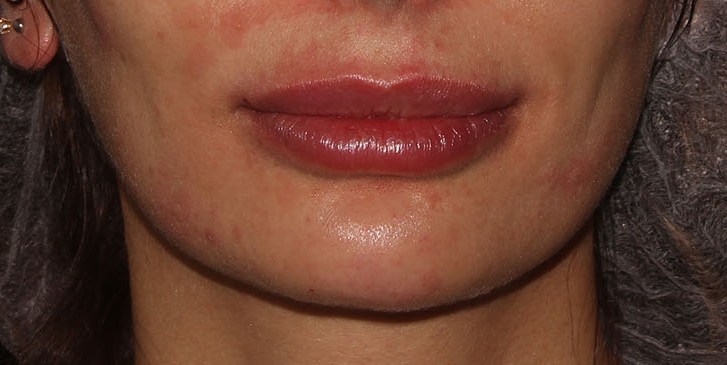 after lip augmentation front closed mouth view female patient case 1541