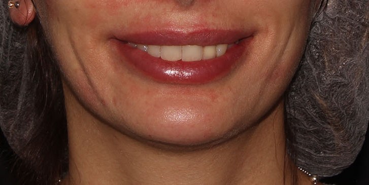 after lip augmentation front open mouth view female patient case 1541