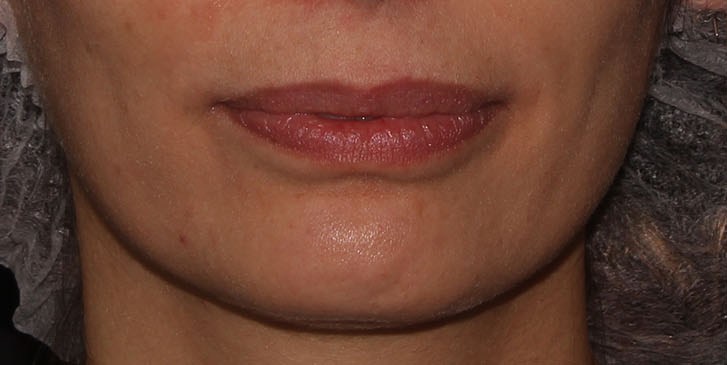 before lip augmentation front closed mouth view female patient case 1541