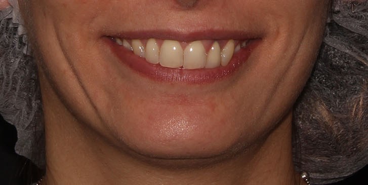 before lip augmentation front open mouth view female patient case 1541
