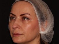 after nonsurgical facelift left angle view female patient case 1893