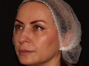 after nonsurgical facelift left angle view female patient case 1893