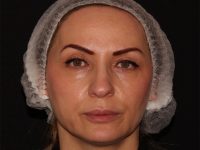 after nonsurgical facelift front view female patient case 1893