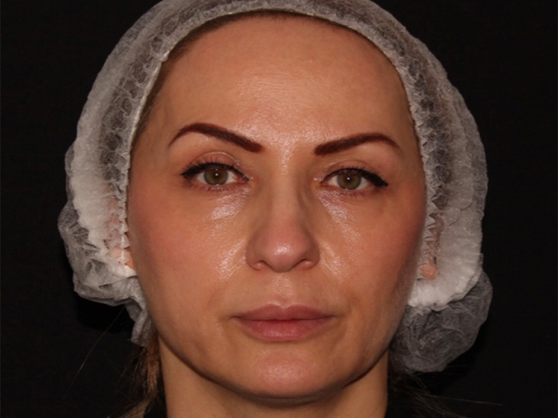 after nonsurgical facelift front view female patient case 1893