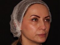 after nonsurgical facelift right angle view female patient case 1893