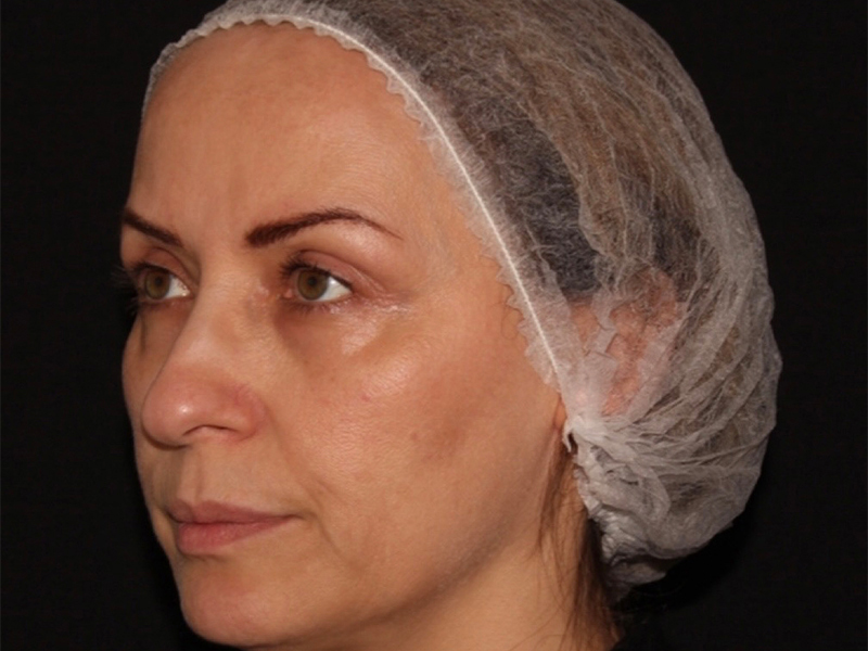 before nonsurgical facelift left angle view female patient case 1893