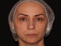 before nonsurgical facelift front view female patient case 1893
