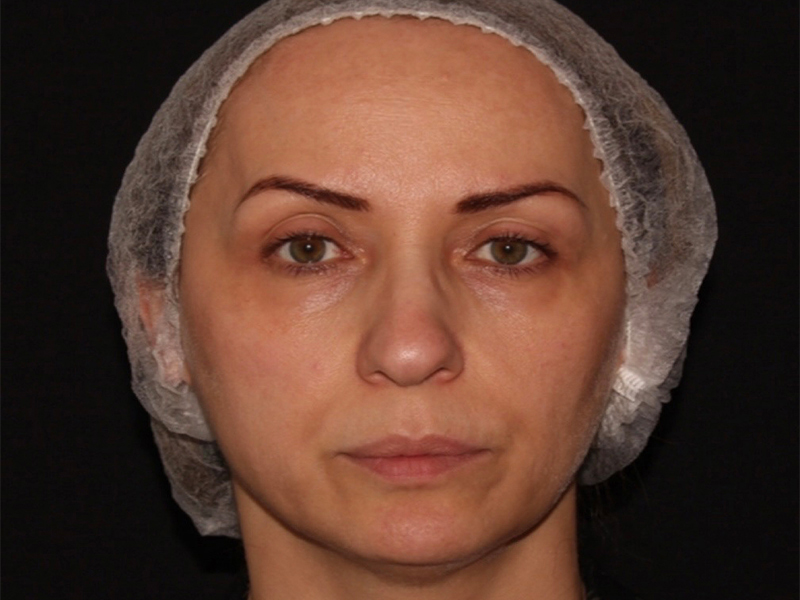 before nonsurgical facelift front view female patient case 1893