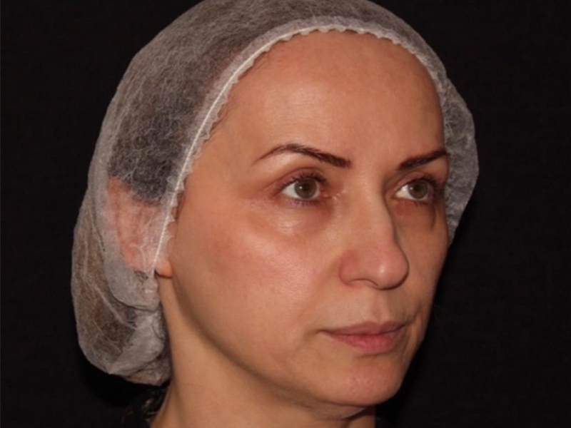 before nonsurgical facelift right angle view female patient case 1893