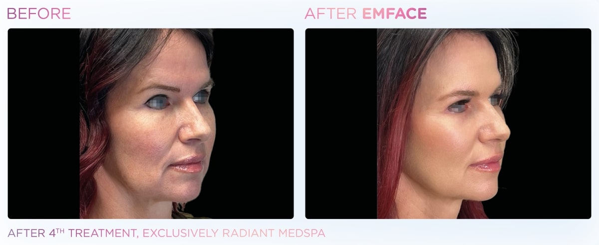 EmFace: Facelift Without Scalpels or Needles