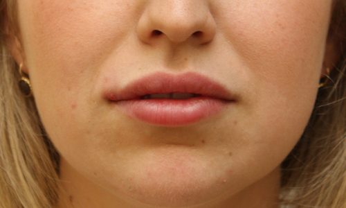 Kabiri-Lip-Filler-after-Vancouver